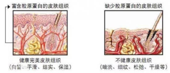 皮肤松弛最主要的原因在于胶原蛋白流失